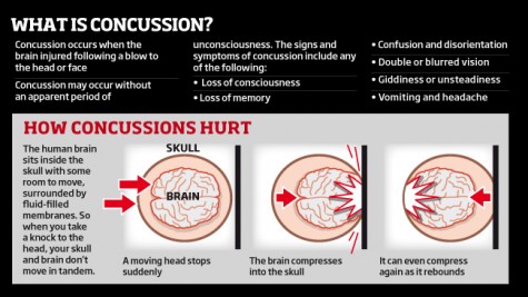 This chart shows the traumatic movements the brain experiences during an impact that causes a concussion.